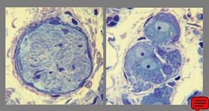 Methylene-blue-stained epoxy-resin semithin section of intestinal unmyelinated vegetative nerve (left)and ganglion cells of plexus submucosus Meissneri (right). (Human, small intestine.) Methylene-blue-stained epoxy-resin semithin section of intestinal unmyelinated vegetative nerve (left)and ganglion cells of plexus submucosus Meissneri (right). (Human, small intestine.)